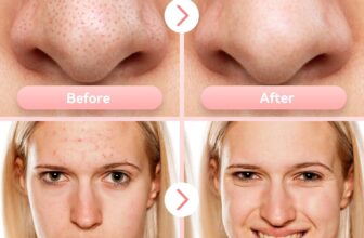 My Pores Were Clogged Until I Tried This FREESHOW Vacuum