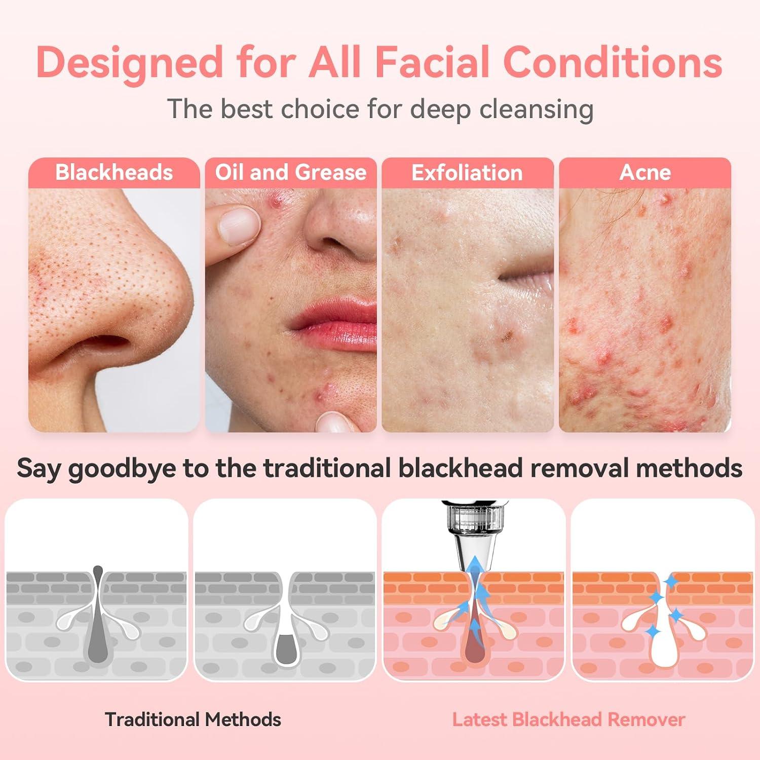 My Pores Were Clogged Until I Tried this FREESHOW Vacuum